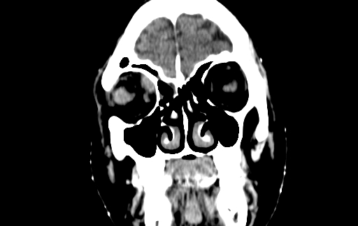 Chronic invasive fungal sinusitis (Radiopaedia 91563-109286 D 14).jpg
