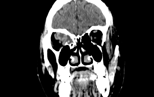Chronic invasive fungal sinusitis (Radiopaedia 91563-109286 D 35).jpg