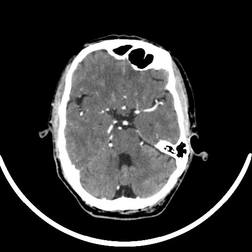 Chronic invasive fungal sinusitis with intraorbital and intracranial extension (Radiopaedia 56387-63046 B 135).jpg