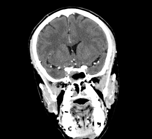 Chronic invasive fungal sinusitis with intraorbital and intracranial extension (Radiopaedia 56387-63046 C 160).jpg