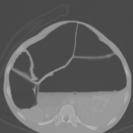 Chronic large bowel pseudo-obstruction (Radiopaedia 43181-46492 Axial bone window 57).jpg