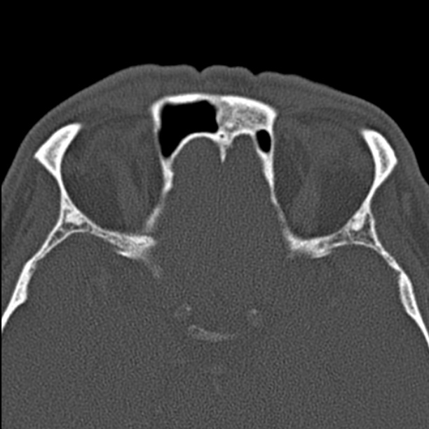 Chronic maxillary sinusitis (Radiopaedia 27879-28116 Axial bone window 42).jpg