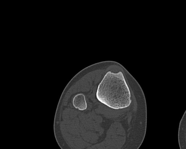Chronic ostemyelitis of the femur with long sinus tract (Radiopaedia 74947-85982 Axial bone window 251).jpg