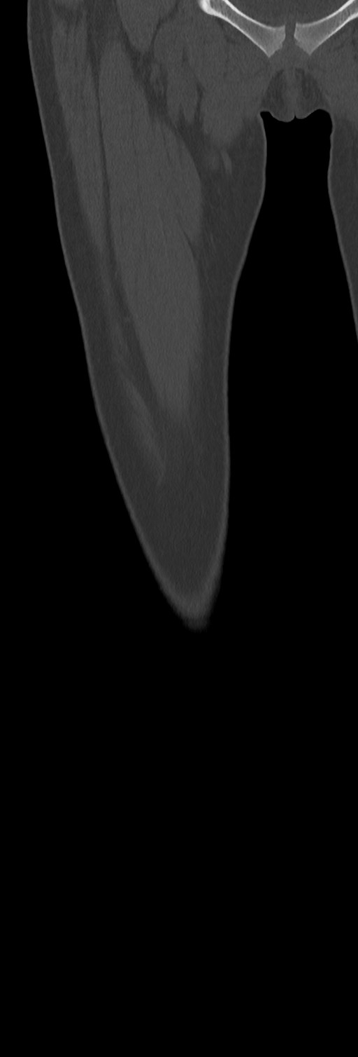 Chronic ostemyelitis of the femur with long sinus tract (Radiopaedia 74947-85982 Coronal bone window 19).jpg
