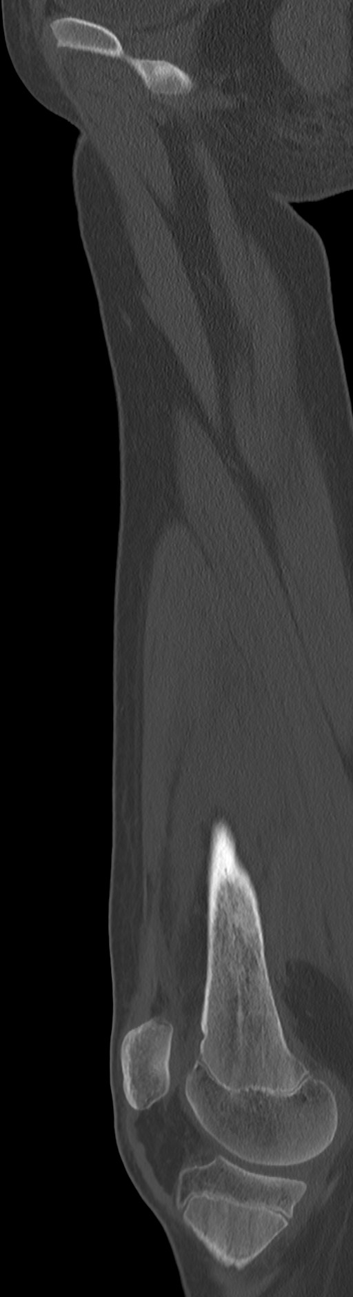 Chronic ostemyelitis of the femur with long sinus tract (Radiopaedia 74947-85982 Sagittal bone window 62).jpg