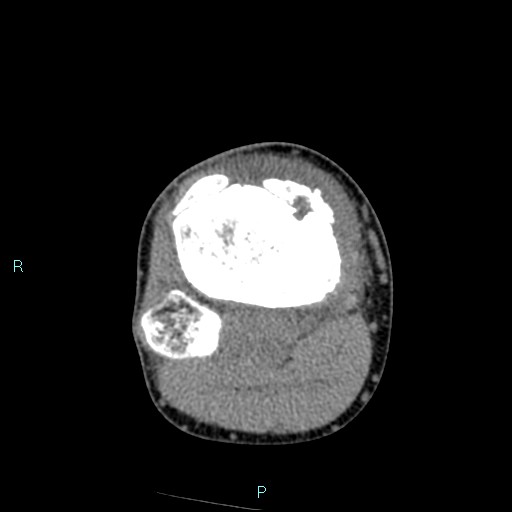 File:Chronic osteomyelitis (with Brodie abscess) (Radiopaedia 76405-88111 A 83).jpg
