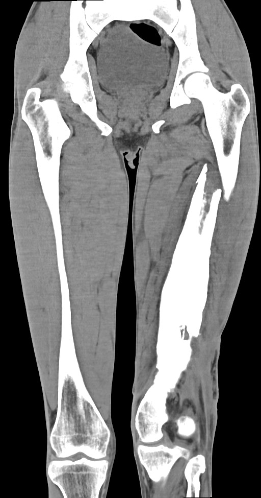 Chronic osteomyelitis (with sequestrum) (Radiopaedia 74813-85822 E 32).jpg