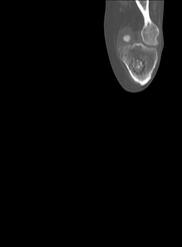 Chronic osteomyelitis - tibia (with sequestrum) (Radiopaedia 73273-84090 Coronal non-contrast 16).jpg