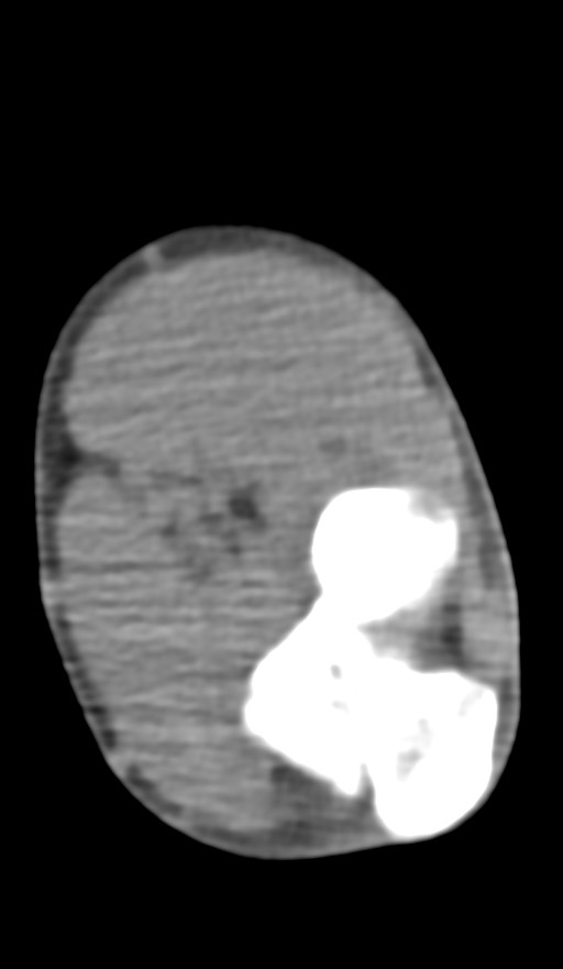 Chronic osteomyelitis of the distal humerus (Radiopaedia 78351-90971 Axial non-contrast 100).jpg
