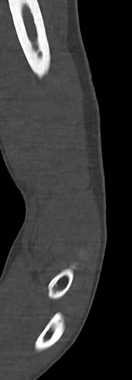 Chronic osteomyelitis of the distal humerus (Radiopaedia 78351-90971 Sagittal bone window 38).jpg