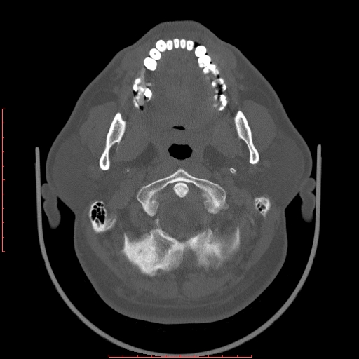 Chronic submandibular sialolithiasis (Radiopaedia 69817-79814 Axial bone window 23).jpg