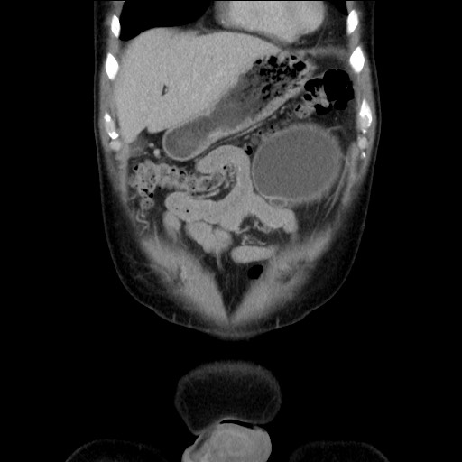 Chronic ureteropelvic junction obstruction (Radiopaedia 78365-90996 B 23).jpg