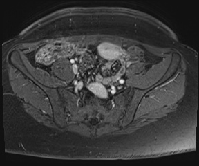 File:Class II Mullerian duct anomaly- unicornuate uterus with rudimentary horn and non-communicating cavity (Radiopaedia 39441-41755 Axial T1 fat sat 13).jpg