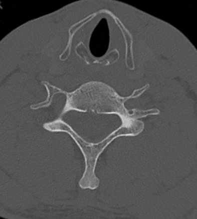 Clay-shoveler fracture (Radiopaedia 14604-14532 Axial bone window 5).jpg