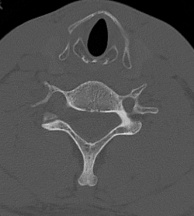 Clay-shoveler fracture (Radiopaedia 14604-14532 Axial bone window 7).jpg