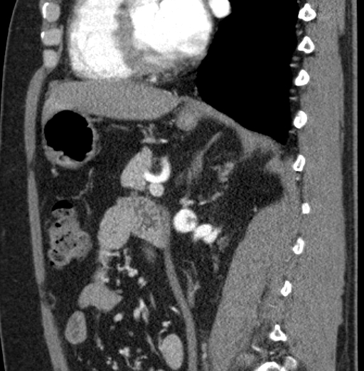 File:Clear cell renal cell carcinoma (Radiopaedia 61449-69393 D 44).jpg