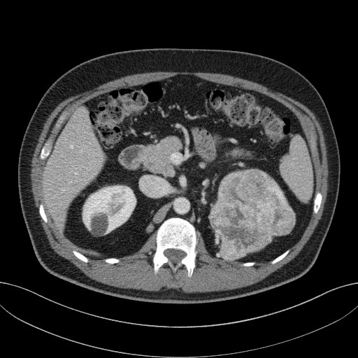 File:Clear cell renal cell carcinoma (Radiopaedia 61449-69393 E 25).jpg