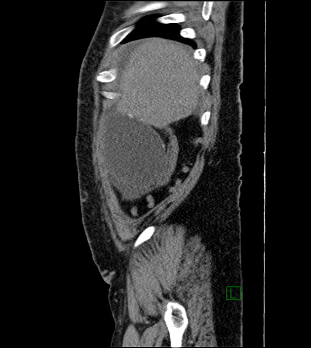 Closed-loop small bowel obstruction-internal hernia (Radiopaedia 78439-91096 C 124).jpg