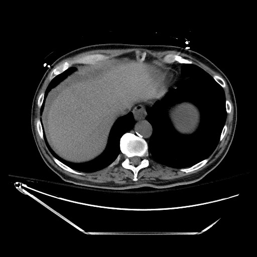 Closed loop obstruction due to adhesive band, resulting in small bowel ischemia and resection (Radiopaedia 83835-99023 Axial non-contrast 25).jpg