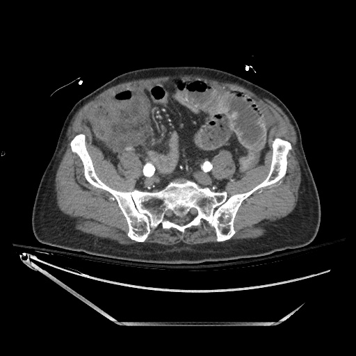 File:Closed loop obstruction due to adhesive band, resulting in small bowel ischemia and resection (Radiopaedia 83835-99023 B 111).jpg