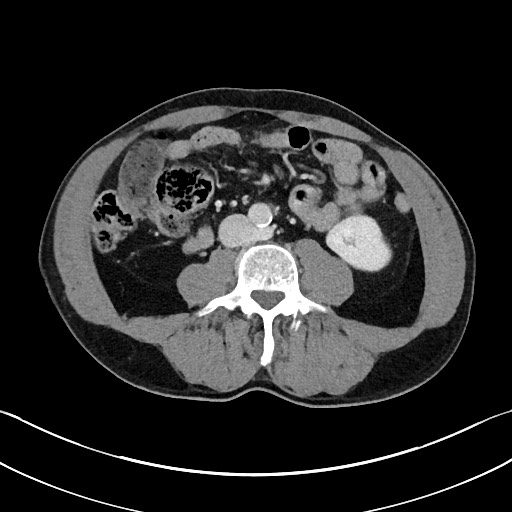 File:Closed loop small bowel obstruction - internal hernia (Radiopaedia 57806-64778 B 68).jpg