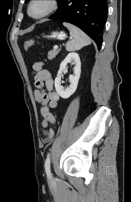 Closed loop small bowel obstruction - internal hernia (Radiopaedia 57806-64778 C 33).jpg