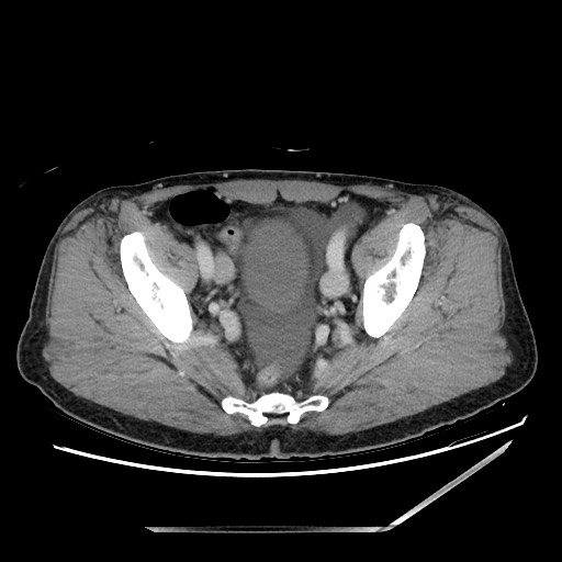 Closed loop small bowel obstruction - omental adhesion causing "internal hernia" (Radiopaedia 85129-100682 A 143).jpg