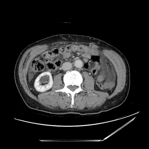 Closed loop small bowel obstruction - omental adhesion causing "internal hernia" (Radiopaedia 85129-100682 A 83).jpg
