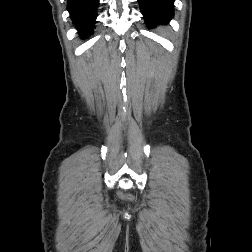 Closed loop small bowel obstruction - omental adhesion causing "internal hernia" (Radiopaedia 85129-100682 B 114).jpg
