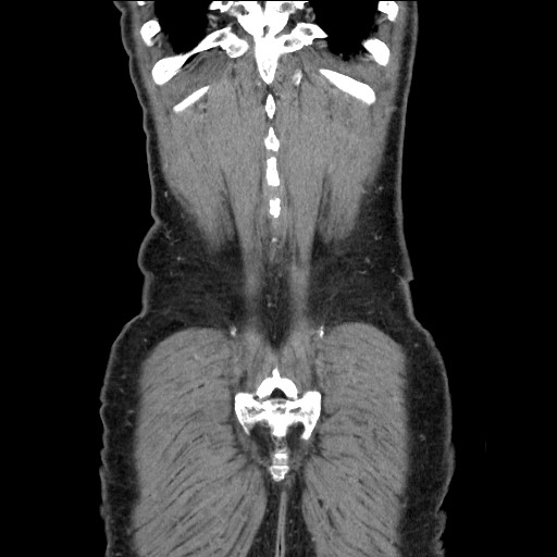 Closed loop small bowel obstruction - omental adhesion causing "internal hernia" (Radiopaedia 85129-100682 B 116).jpg