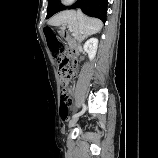 File:Closed loop small bowel obstruction - omental adhesion causing "internal hernia" (Radiopaedia 85129-100682 C 72).jpg