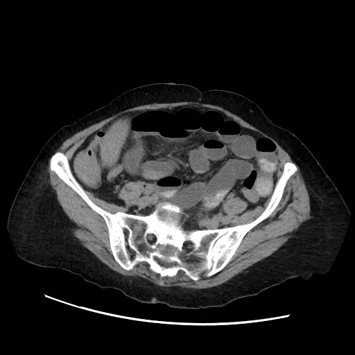 Closed loop small bowel obstruction due to adhesive band, with intramural hemorrhage and ischemia (Radiopaedia 83831-99017 Axial non-contrast 114).jpg