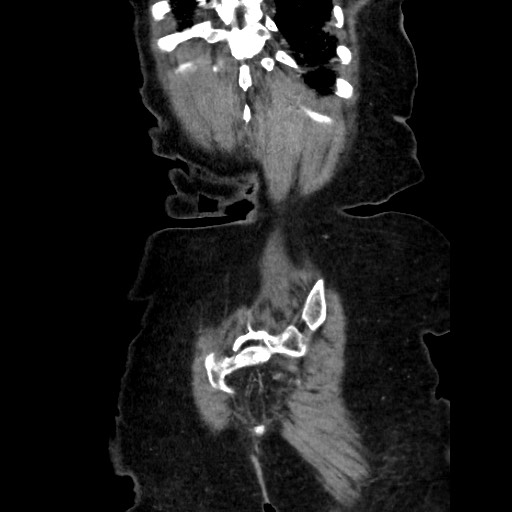 Closed loop small bowel obstruction due to adhesive band, with intramural hemorrhage and ischemia (Radiopaedia 83831-99017 C 111).jpg