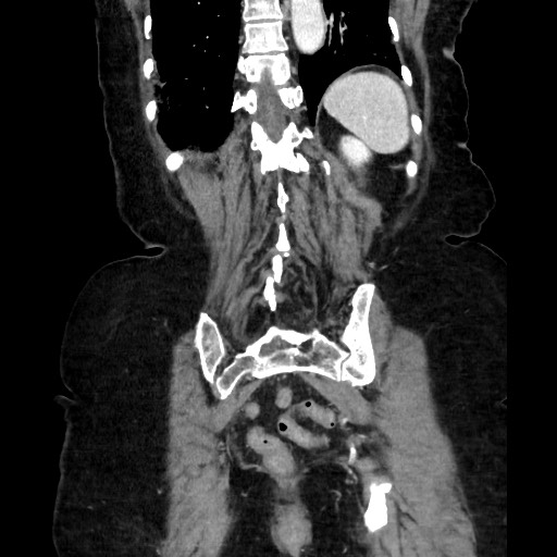 Closed loop small bowel obstruction due to adhesive band, with intramural hemorrhage and ischemia (Radiopaedia 83831-99017 C 99).jpg