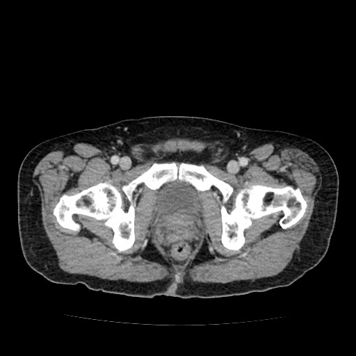 File:Closed loop small bowel obstruction due to adhesive band - U-shaped loop (Radiopaedia 83829-99012 A 70).jpg