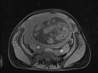 Closed loop small bowel obstruction in pregnancy (MRI) (Radiopaedia 87637-104031 F 32).jpg