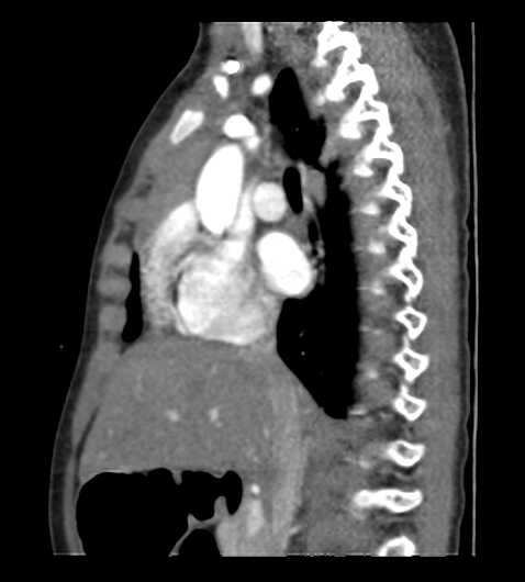 File:Coarctation of aorta (Radiopaedia 27427-27622 Sagittal C+ CTPA 51).png