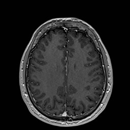 File:Cochlear incomplete partition type III associated with hypothalamic hamartoma (Radiopaedia 88756-105498 Axial T1 C+ 131).jpg