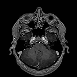 File:Cochlear incomplete partition type III associated with hypothalamic hamartoma (Radiopaedia 88756-105498 Axial T1 C+ 59).jpg