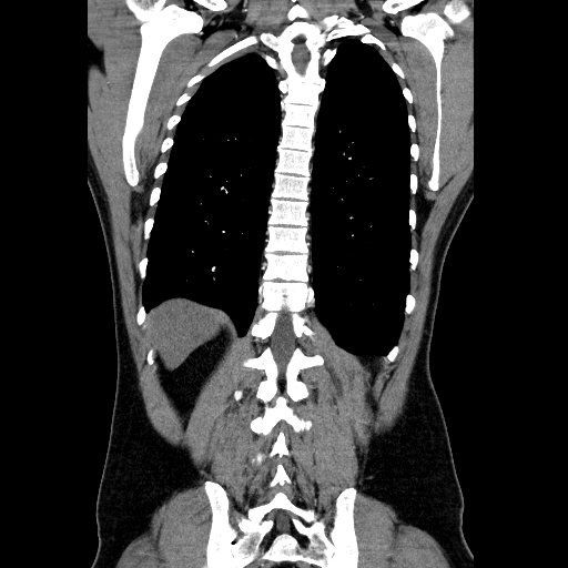 File:Codominant double aortic arch (Radiopaedia 56012-62637 B 37).jpg