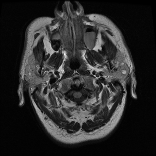 File:Colloid cyst (large) (Radiopaedia 34415-35729 Axial FLAIR 1).png