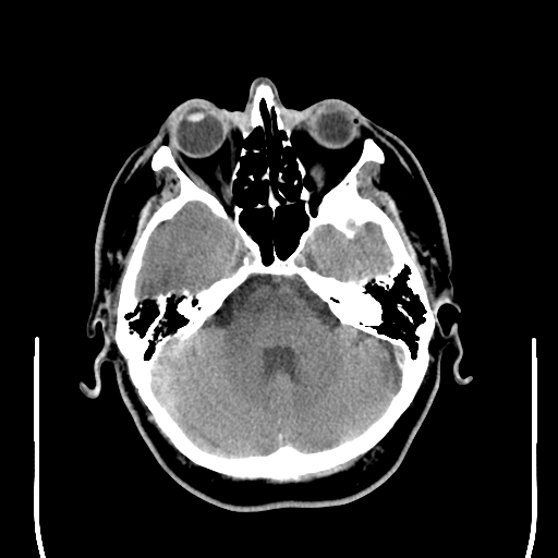 File:Colloid cyst (large) (Radiopaedia 34415-35734 Axial non-contrast 18).png