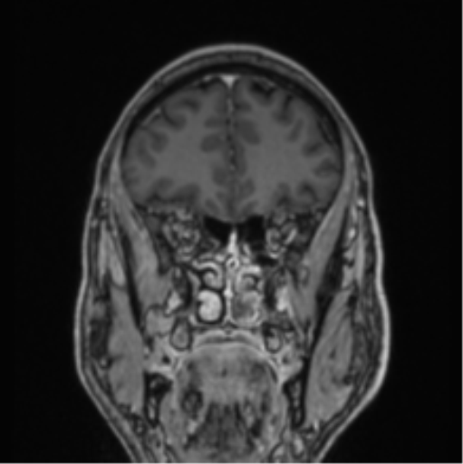File:Colloid cyst of the third ventricle (Radiopaedia 86571-102662 Coronal T1 C+ 71).png