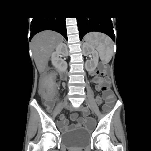 File:Colocolic fistula - Crohn disease (Radiopaedia 57063-63955 B 26).jpg