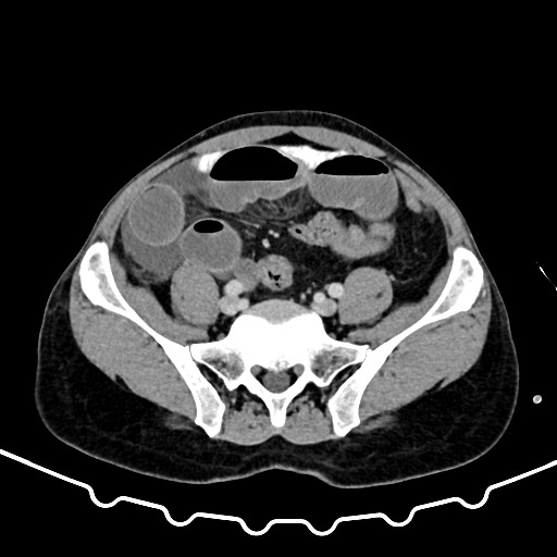 Colocolic intussusception due to large lipoma (Radiopaedia 68773-78482 A 139).jpg