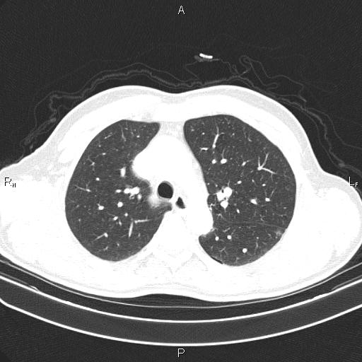 File:Colon cancer (Radiopaedia 85663-101443 Axial lung window 21).jpg