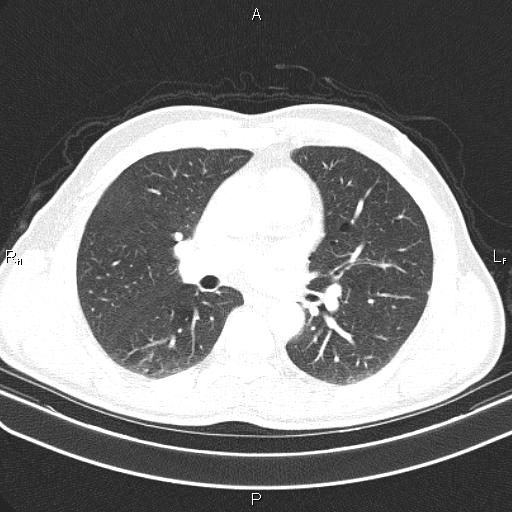 File:Colon cancer (Radiopaedia 85663-101443 Axial lung window 31).jpg