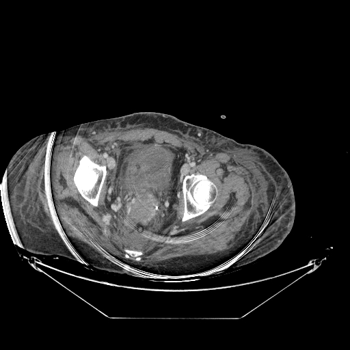 Colonic infarction after colostomy creation (Radiopaedia 81157-94797 A 248).jpg