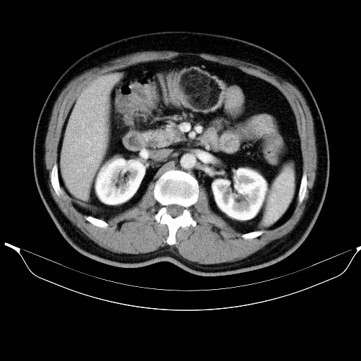 Colonic lipoma with colo-colic intussusception (Radiopaedia 58944-66200 A 23).jpg