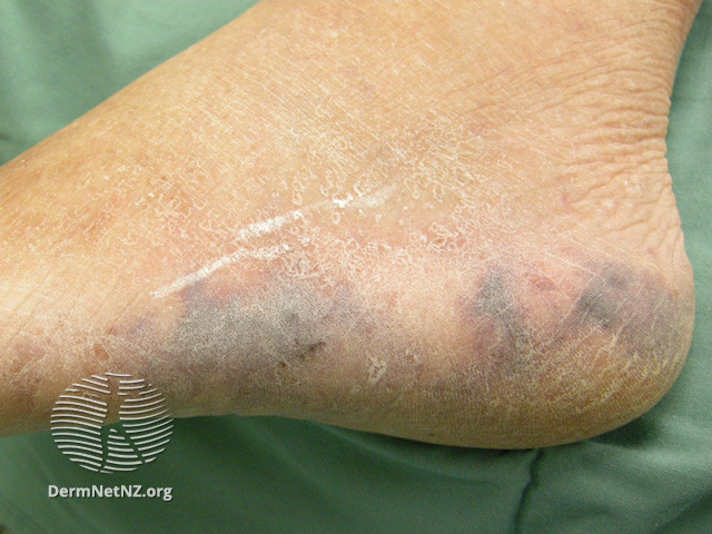File:Cryoglobulinaemia (DermNet NZ site-age-specific-ulcer-53).jpg